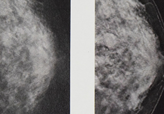 乳房X線撮影
