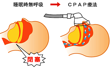 CPAP治療